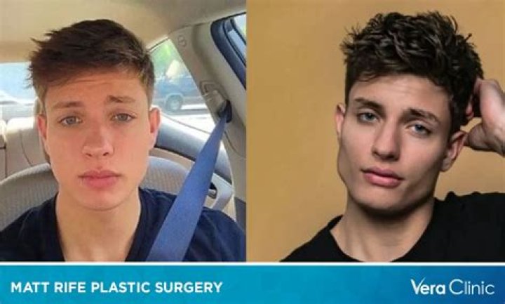 Did Matt Rife Have Plastic Surgery? Before and After Updates