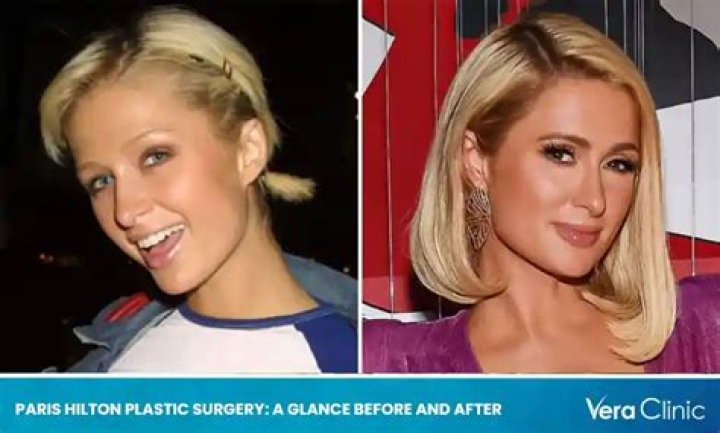 Has Paris Hilton had Plastic Surgery? Get Details Here